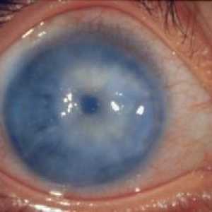 Sekundarni glaukom očiju: liječenje, uzroci, klasifikacija, simptomi, znakovi