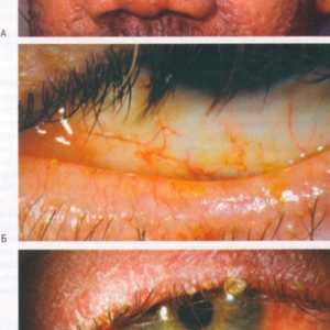 Bolesti spojnice očni rosacea
