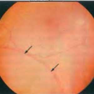 Bolesti periferiji mrežnice: degenerativne retinoshiza