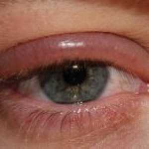 Bolesti stoljeća ljudskog oka: liječenje, sprječavanje, znakovi, simptomi, uzroci