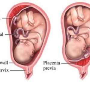 Kašnjenje u maternici i posteljica njegovih dijelova