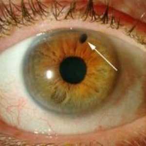 Glaukom kut-zatvarač: liječenja, simptomi, uzroci, simptomi